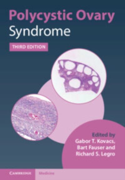 Polycystic Ovary Syndrome